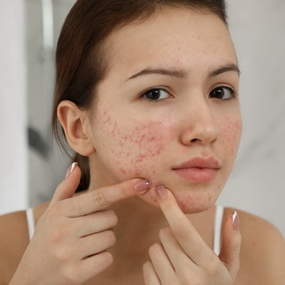 Pimples Treatment in Islamabad